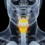 Illustration of stage 2 throat cancer with anatomy