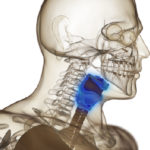 Illustration of stage 3 throat cancer with anatomy