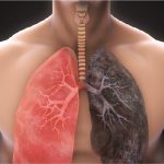 surgery for lung cancer