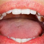 Photograph representative of a mouth cancer patient