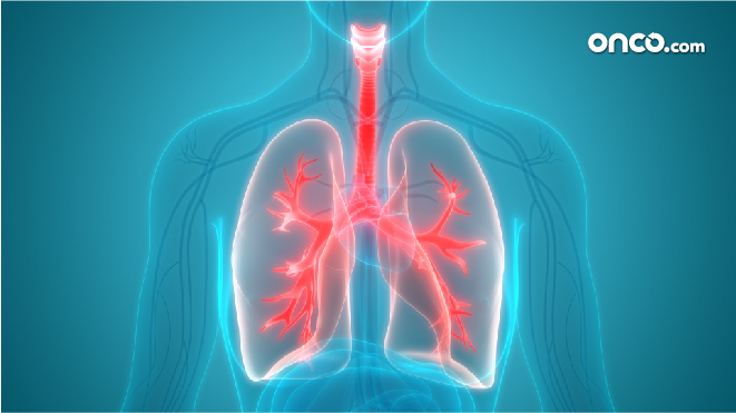 causes of lung cancer