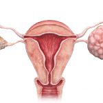 Is ovarian cancer hereditary?