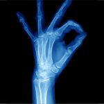 Picture of a x-ray of a hand