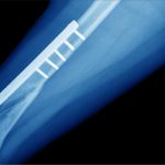 Implants in bone cancer treatment