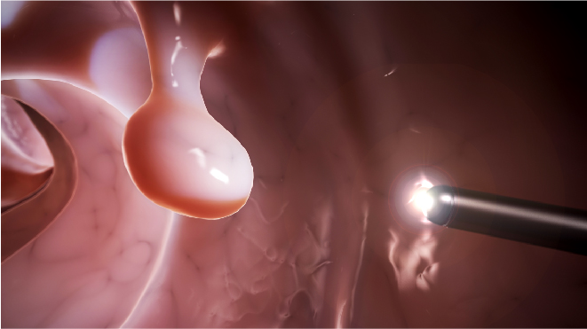 Picture of a patient being examined for colon cancer