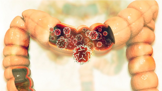 Visual representation of colon cancer in a large intestine