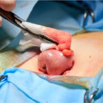 Picture of a patient having a surgery for colon cancer