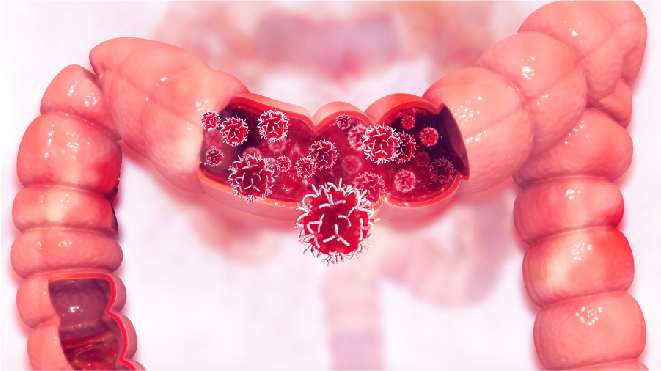 Visual representation of colon cancer in a large intestine