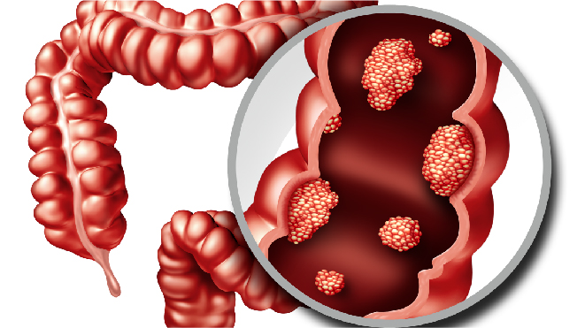 Visual representation of colon cancer under a microscope