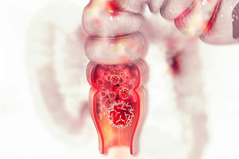 Stage 4 Colon Cancer Life Expectancy