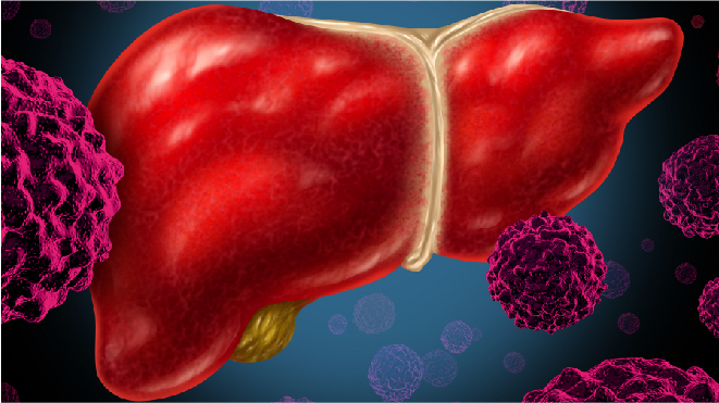 Visual representation of a liver being infected by cancer