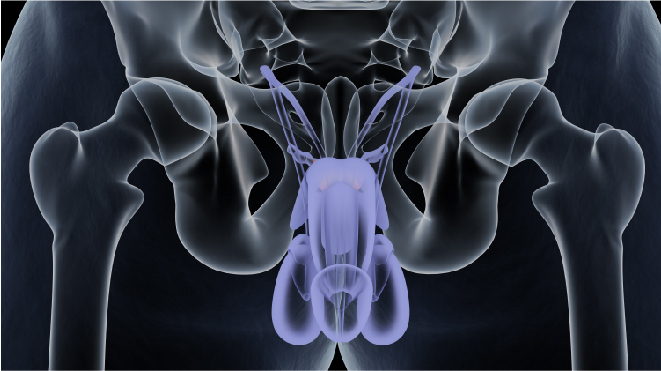 După probleme chirurgicale de adenom de prostată în rect - Cancer rectal traitement chirurgical