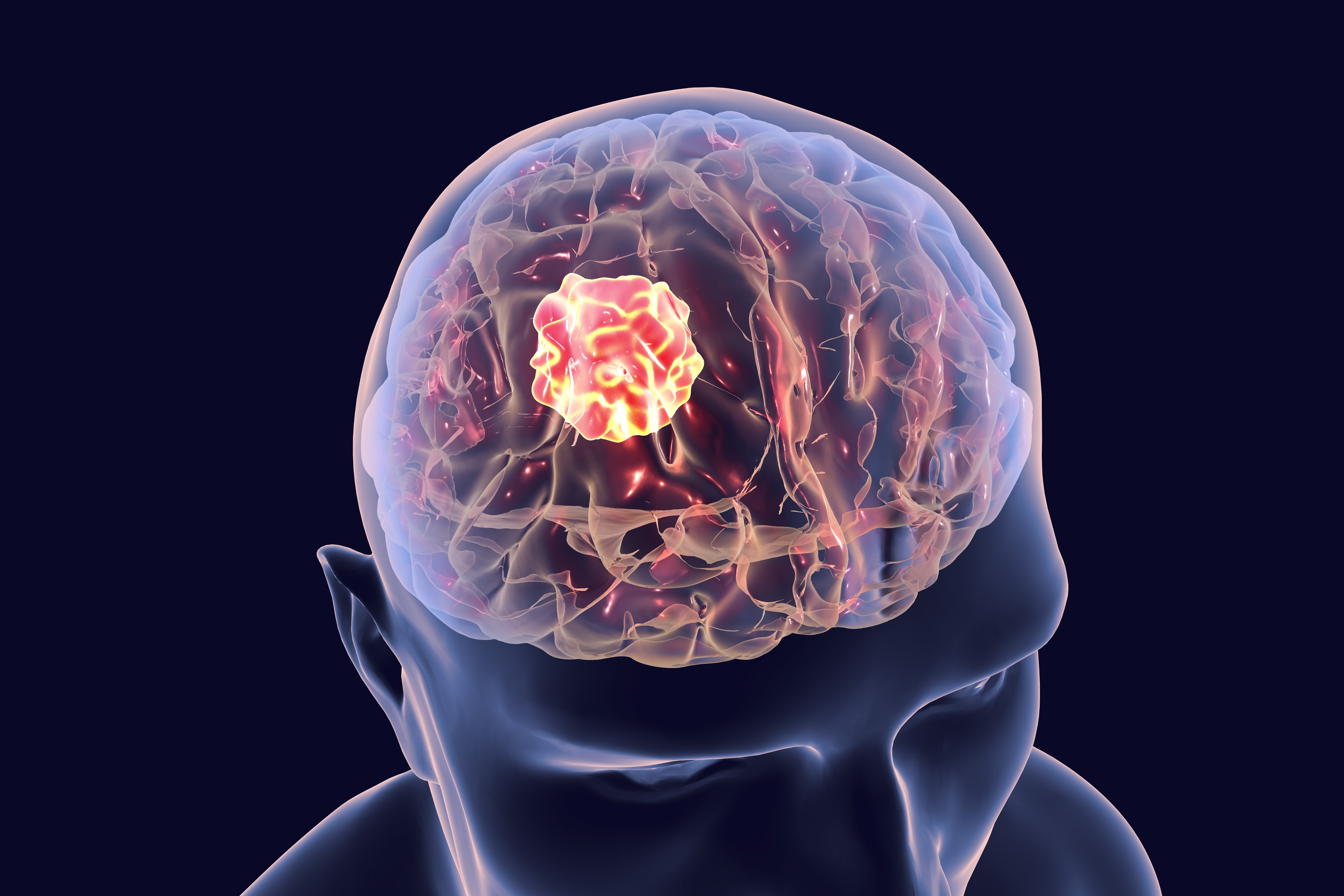 case study of brain tumor