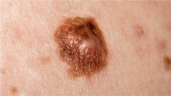 Picture of a lesion on a patient