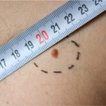 Picture of a measuring tape on the skin lesion