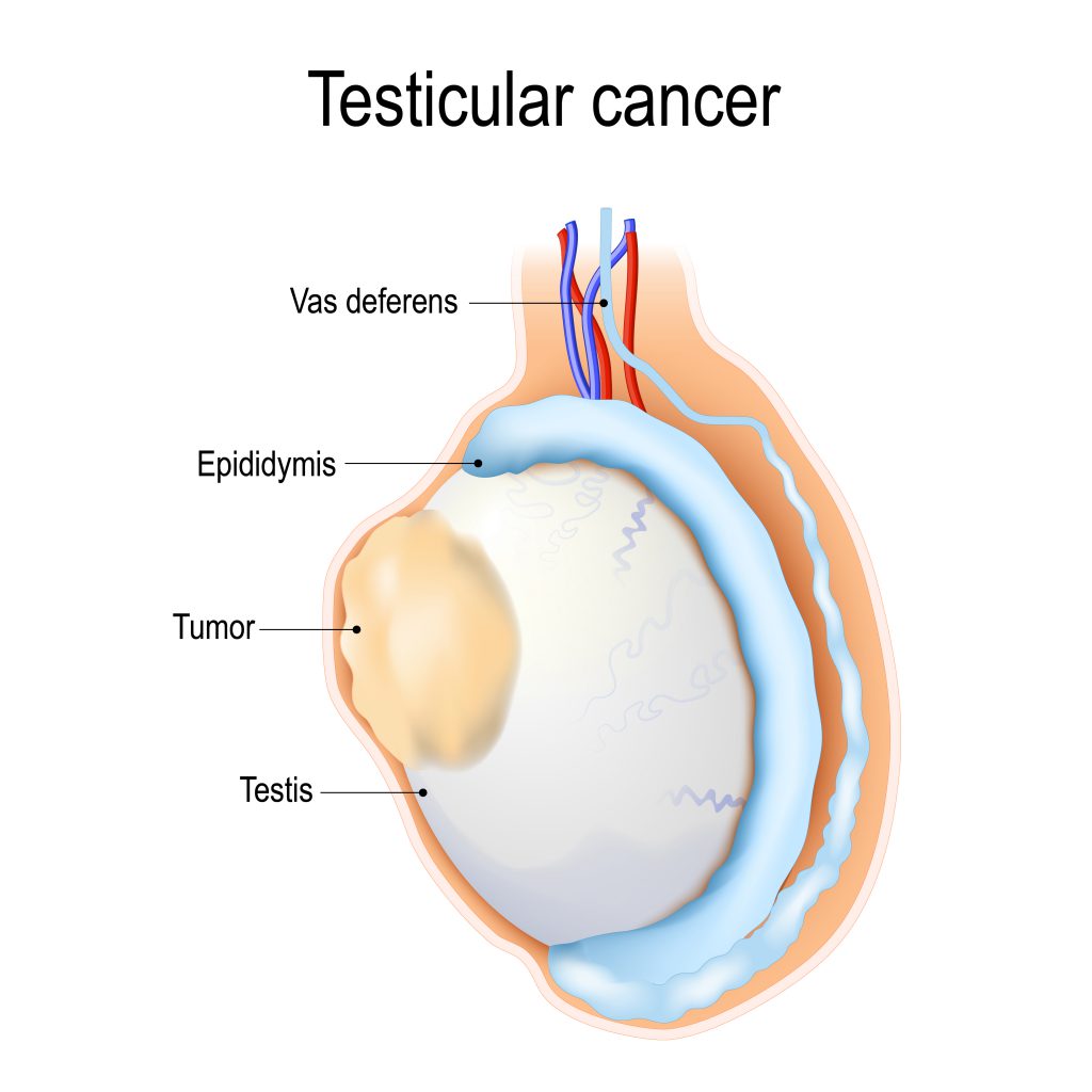testicular cancer causes
