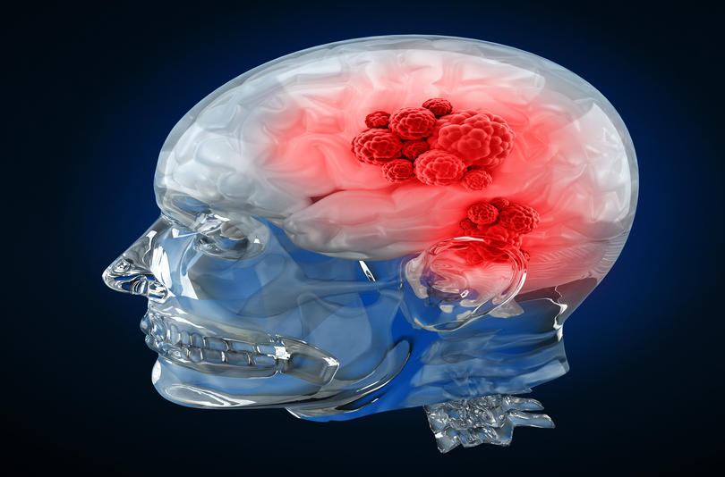 Visualisation of a human with brain cancer