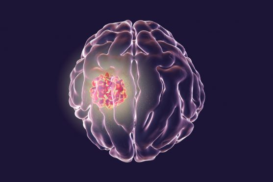 ब्रेन ट्यूमर का पहला लक्षण (Brain tumour signs)