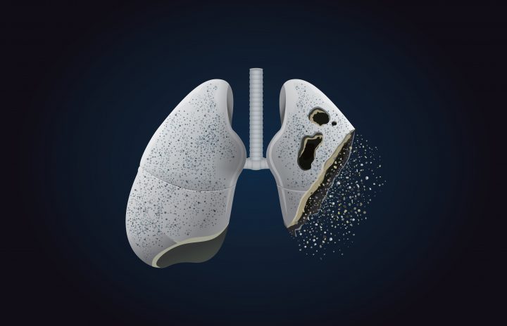7 symptoms of lung cancer