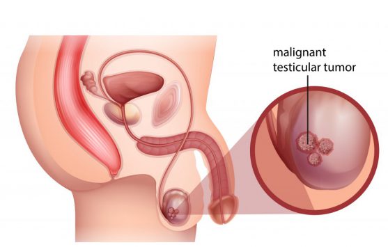 Warning signs of testicular cancer