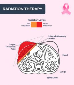 Demystifying Breast Cancer And Its Treatment 