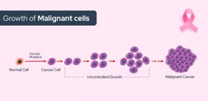 Demystifying Breast Cancer And Its Treatment | Onco.com