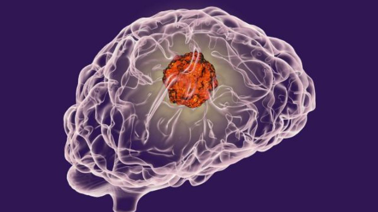 5 Warning Signs of Brain Tumours and Their Treatment | Onco.com