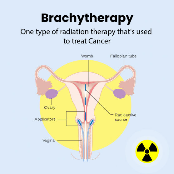 brachytherapy for cervical cancer