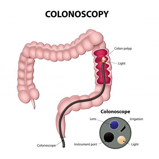 cancer screening colonoscopy