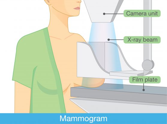 cancer screening mammography