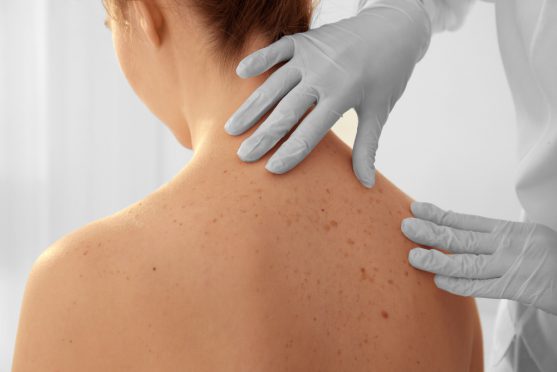 रेडिएशन उपचार क्षेत्र में स्वस्थ त्वचा कोशिकाओं को प्रभावित कर सकता है।