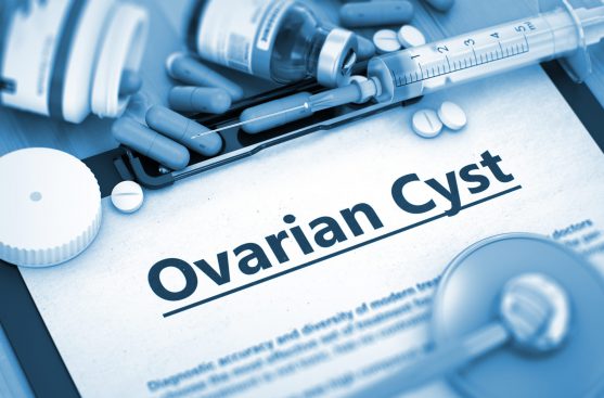 कई बार ओवेरियन सिस्ट के कोई लक्षण नहीं होते हैं।