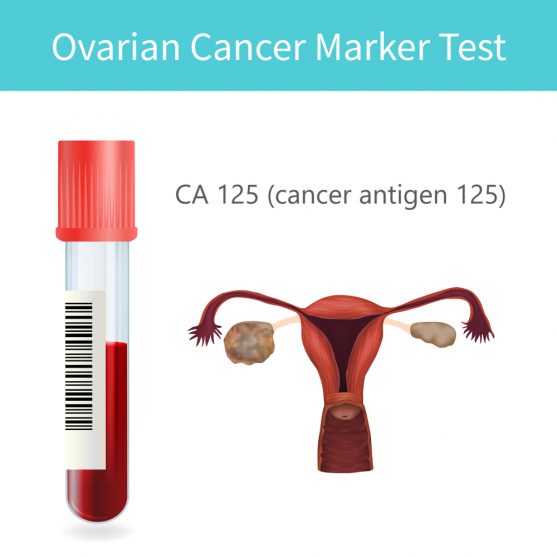 ovarian cancer CA125