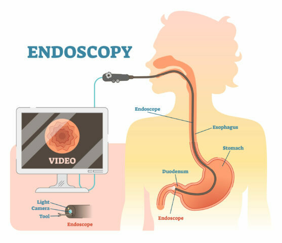 edocspory for carcinoid tumour diagnosis