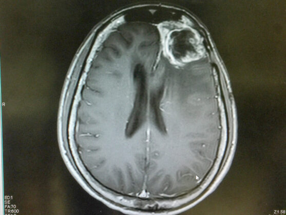 brain scan for glioblastoma