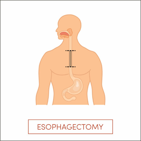 Esophagectomy is done to remove cancerous part of the esophagus and small part of the stomach if necessary