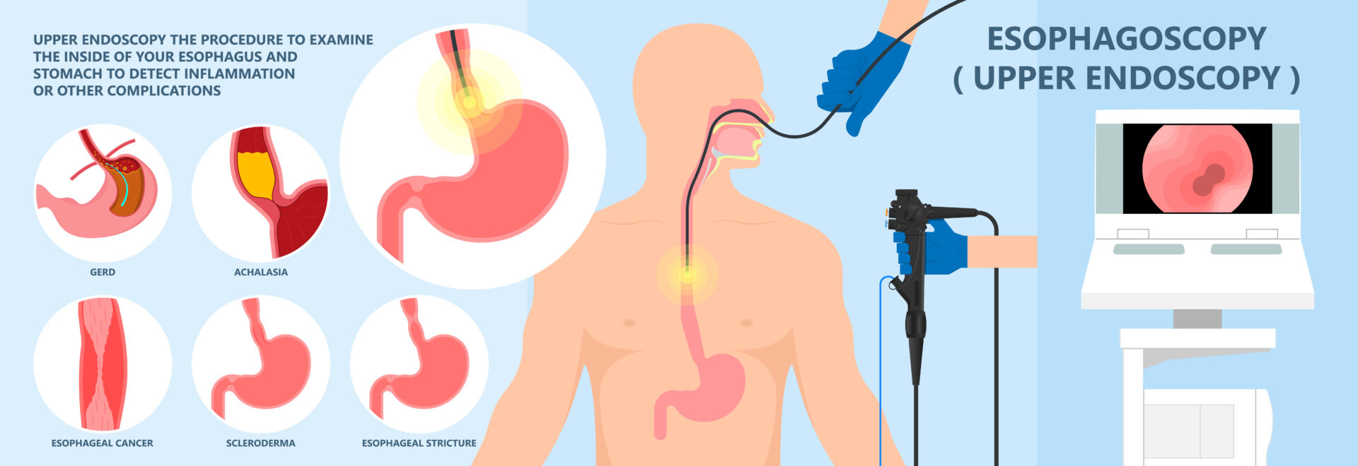 Endoscopy is performed by inserting a lighting tube also called Endoscope into the esophagus