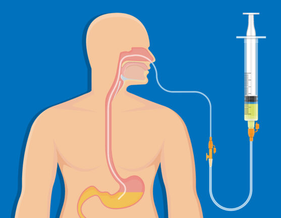 Nasogastric tube is inserted through the nose into the stomach for food intake