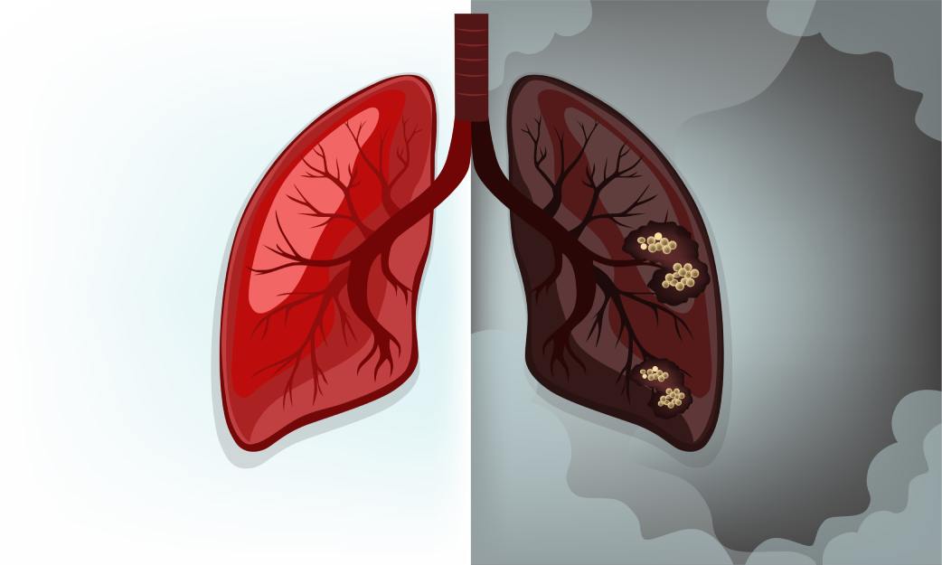 Lung cancer is caused mainly due to smoking